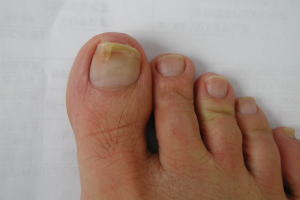 爪 白癬 菌 [画像あり]爪水虫の症状と放置した場合の危険性について