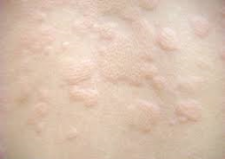 じんま疹の治療 うえの皮フ科 神戸市灘区の皮膚科 アレルギー科 美容皮膚科