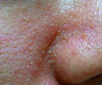 脂漏性湿疹について