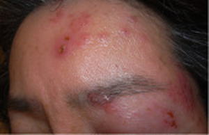 帯状疱疹の臨床写真