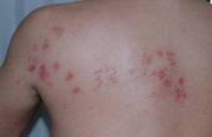 背中の帯状疱疹の臨床写真