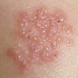 帯状疱疹の臨床写真
